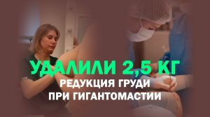 Уменьшение груди на 2,5 кг: как изменилась фигура спустя 2,5 месяца
