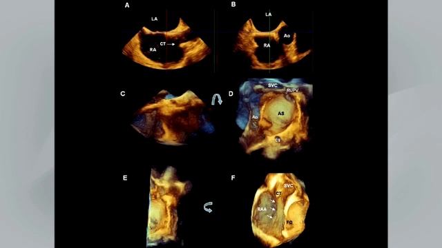 Guidelines for the Echocardiographic Assessment of Atrial Septal Defect & Patent Foramen Ovale смотреть онлайн