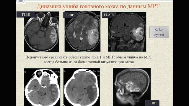 Травматические кровоизлияния 1