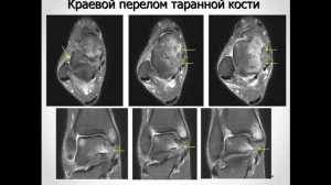 Базовый курс по МРТ  b  Лекция «МР семиотика повреждений голеностопного сустава»  Лектор  Учеваткин