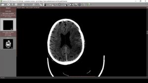 Нарушения мозгового кровообращения 2 КТ ОНМК