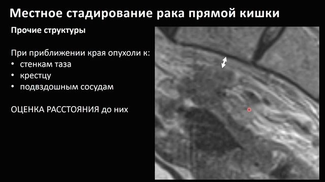 Опухоли прямой кишки 3