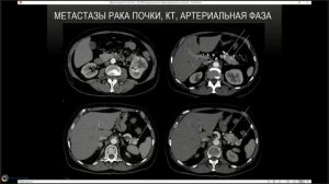 Нейроэндокринные опухоли поджелудочной железы Часть 2