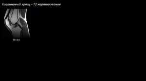 Анатомия и повреждение хряща коленного сустава и остеохондральные повреждения  Учеваткин А.А Часть 1