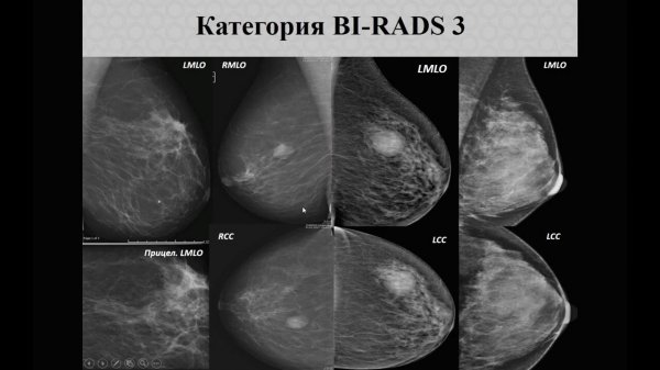 МАММОГРАФИЯ Лекция «Система оценки BI RADS, использование в повседневной практике» 2