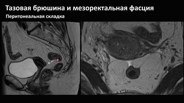 МРТ. Опухоли прямой кишки 2