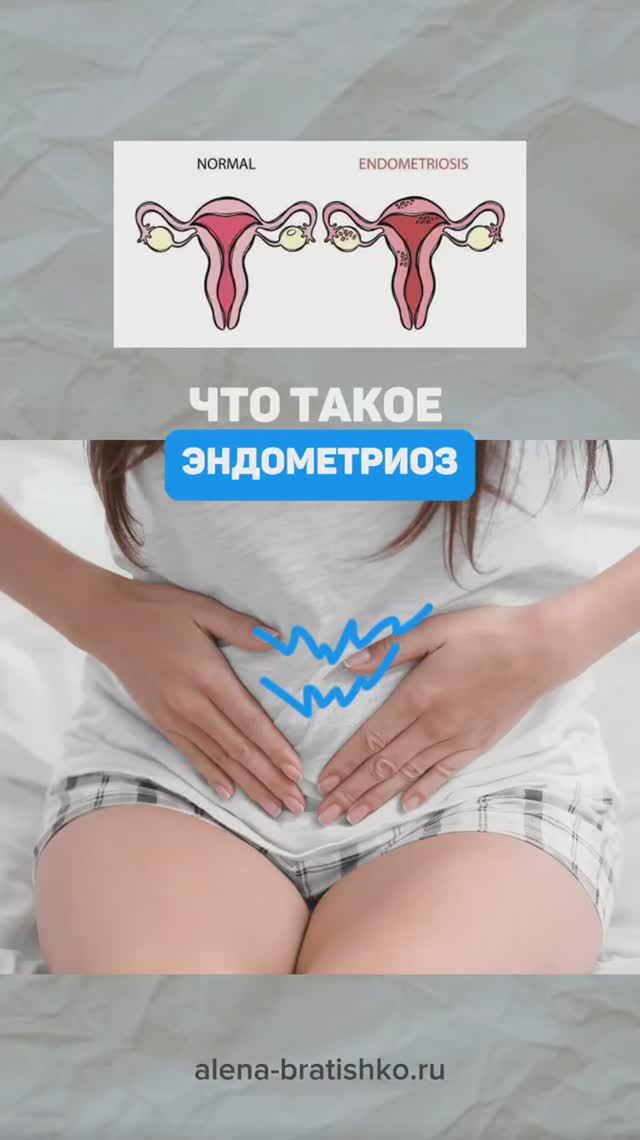 Что такое эндометриоз. Семейный доктор Алена Братишко смотреть онлайн