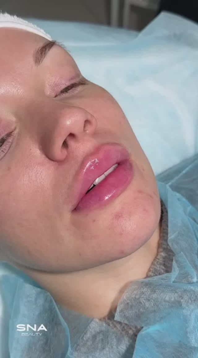 Результат работы  филлером  Resaltys HA®