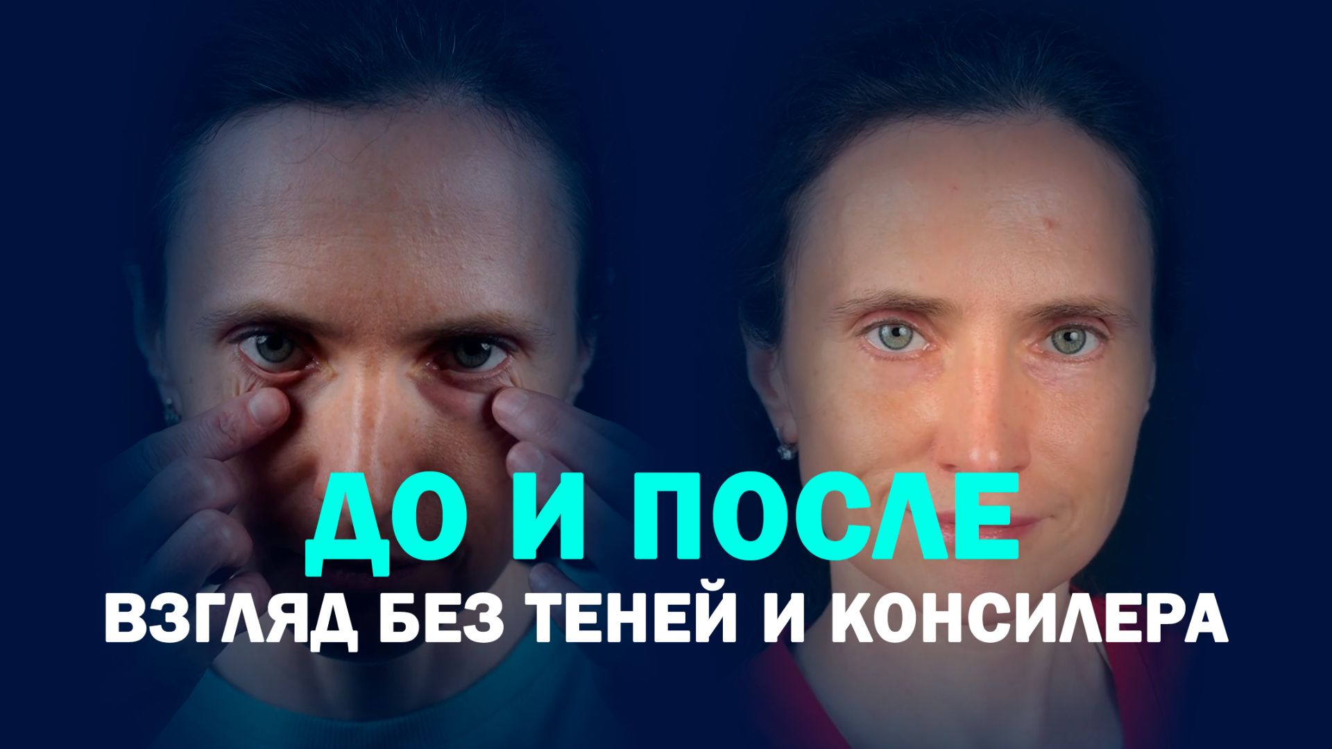 Расширенная нижняя блефаропластика с миопексией: мягкий переход вместо слезной борозды