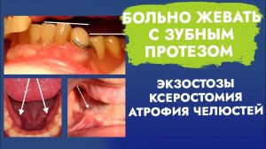 Боль от съемного протеза, которая сама по себе не пройдет.