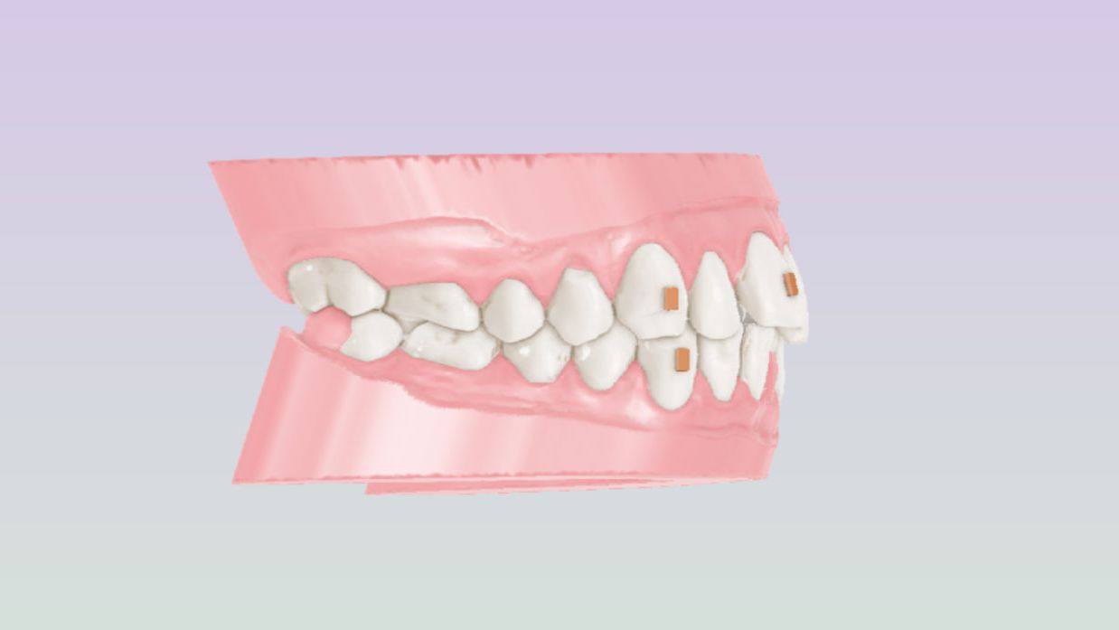 Maestro 3D. Как быстро создать модели для элайнеров.