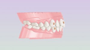 Maestro 3D. Как быстро создать модели для элайнеров.