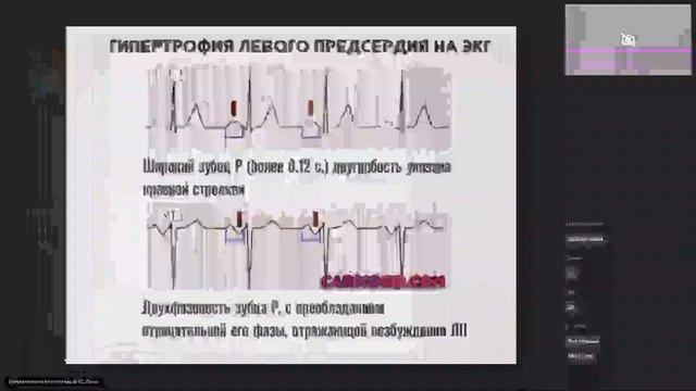 Электрическая ось и гипертрофии отделов сердца смотреть онлайн