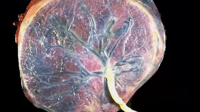 Преждевременное отслоение плаценты смотреть онлайн