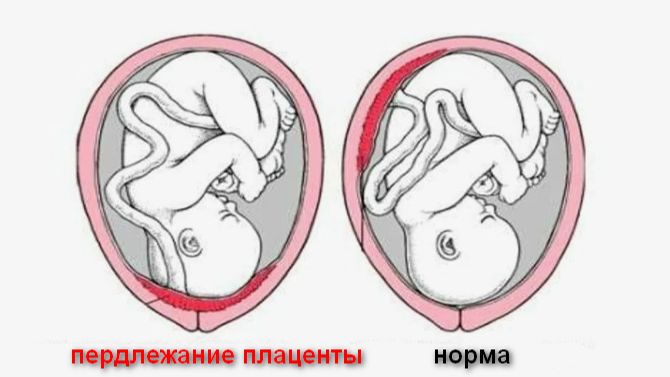 Что такое предлежание плаценты смотреть онлайн