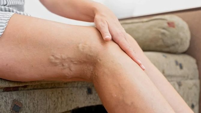 Варикозное расширение вен при беременности смотреть онлайн