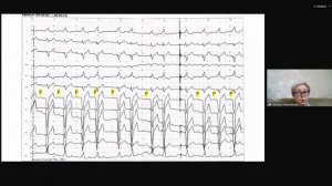 Основные подходы к интерпретации ЭКГ у пациентов с ЭКС при холтеровском мониторировании