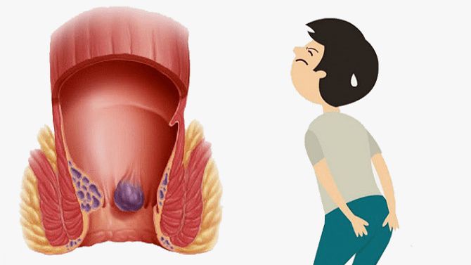 Геморрой во время беременности смотреть онлайн