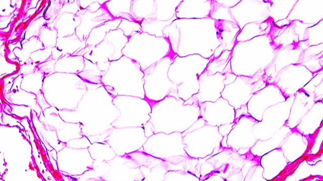 Мезенхимальные и меланоцитарные опухоли. Опухоли нервной системы, герминоклеточные опухоли смотреть онлайн