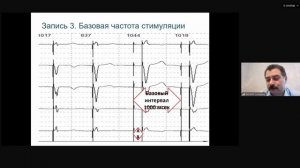 Электрокардиостимуляция при холтеровском мониторировании