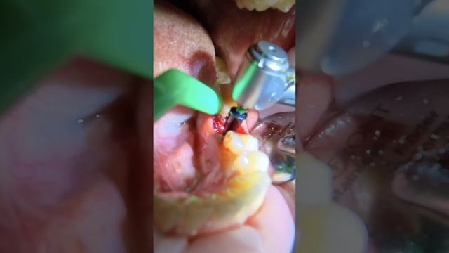 Удаление зуба  и одномоментная имплантация