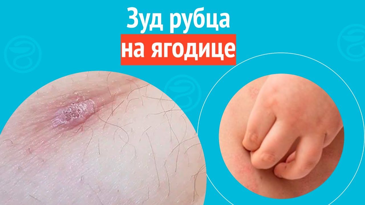 🦵 Зуд рубца на ягодице. Клинический случай №1540 смотреть онлайн