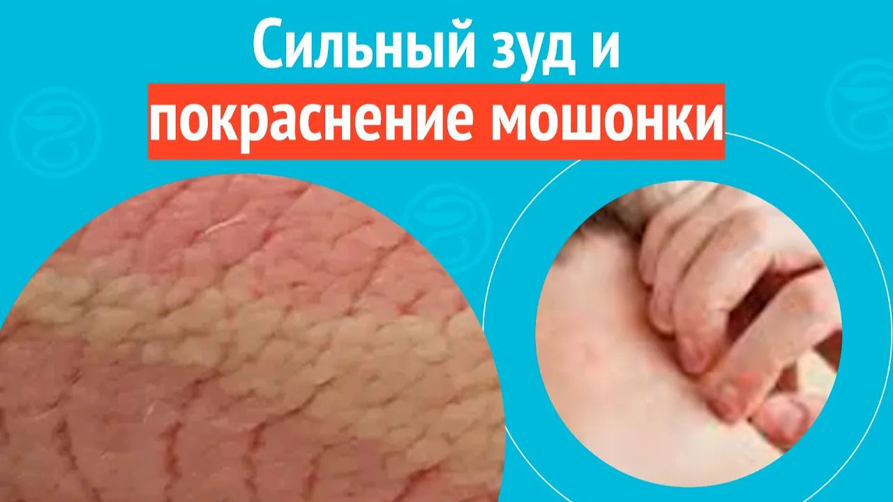 😡 Сильный зуд и покраснение мошонки. Клинический случай №1541 смотреть онлайн