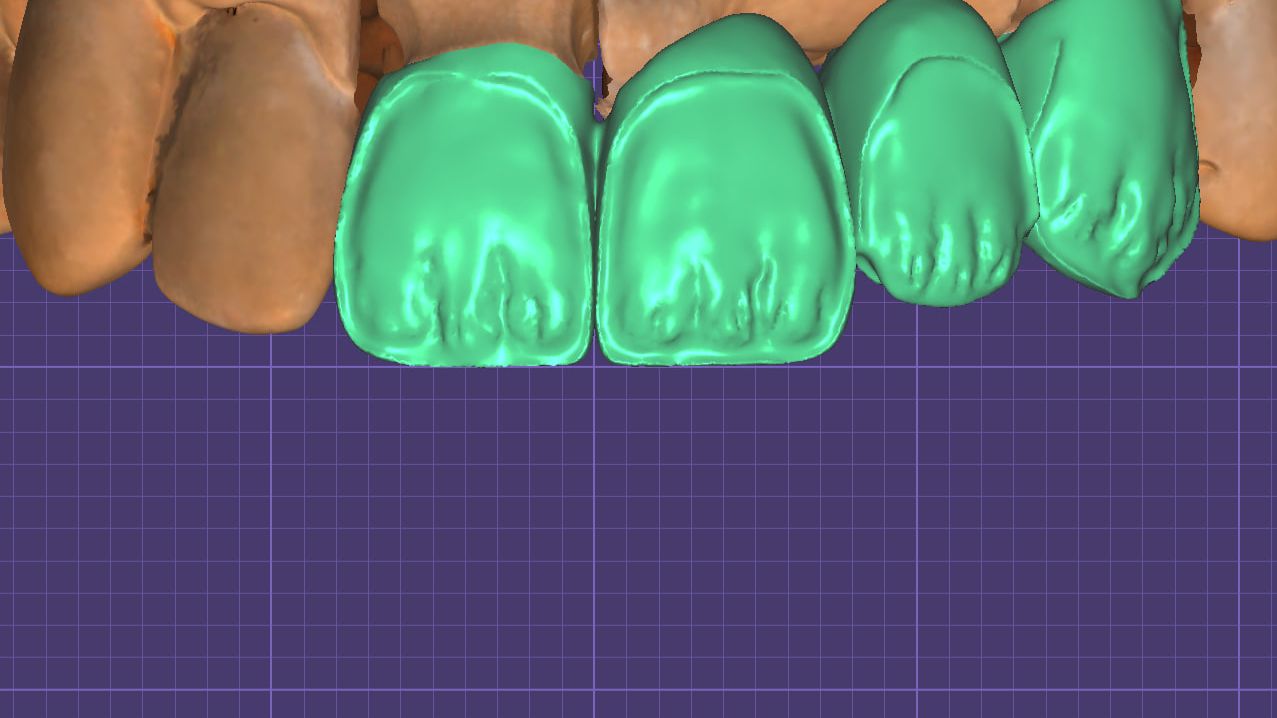 Мамелоны в Exocad. смотреть онлайн