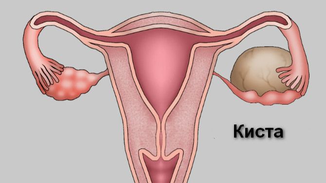 Киста яичника во время беременности смотреть онлайн