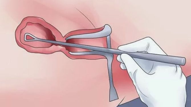 Кюретаж полости матки смотреть онлайн