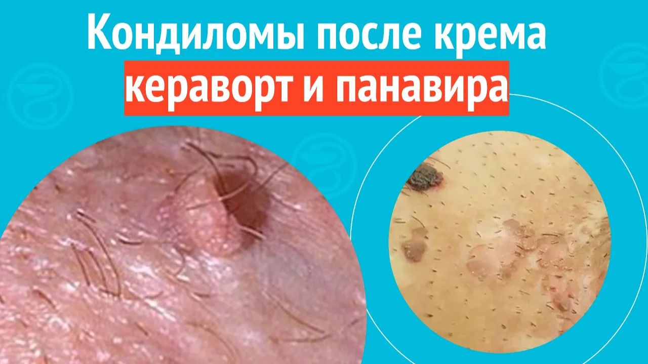 😠 Кондиломы после крема кераворт и панавира. Клинический случай №1535 смотреть онлайн