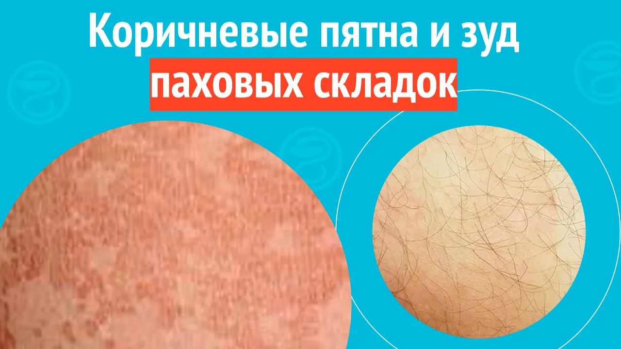 ⏩ Коричневые пятна и зуд паховых складок. Клинический случай №1537 смотреть онлайн