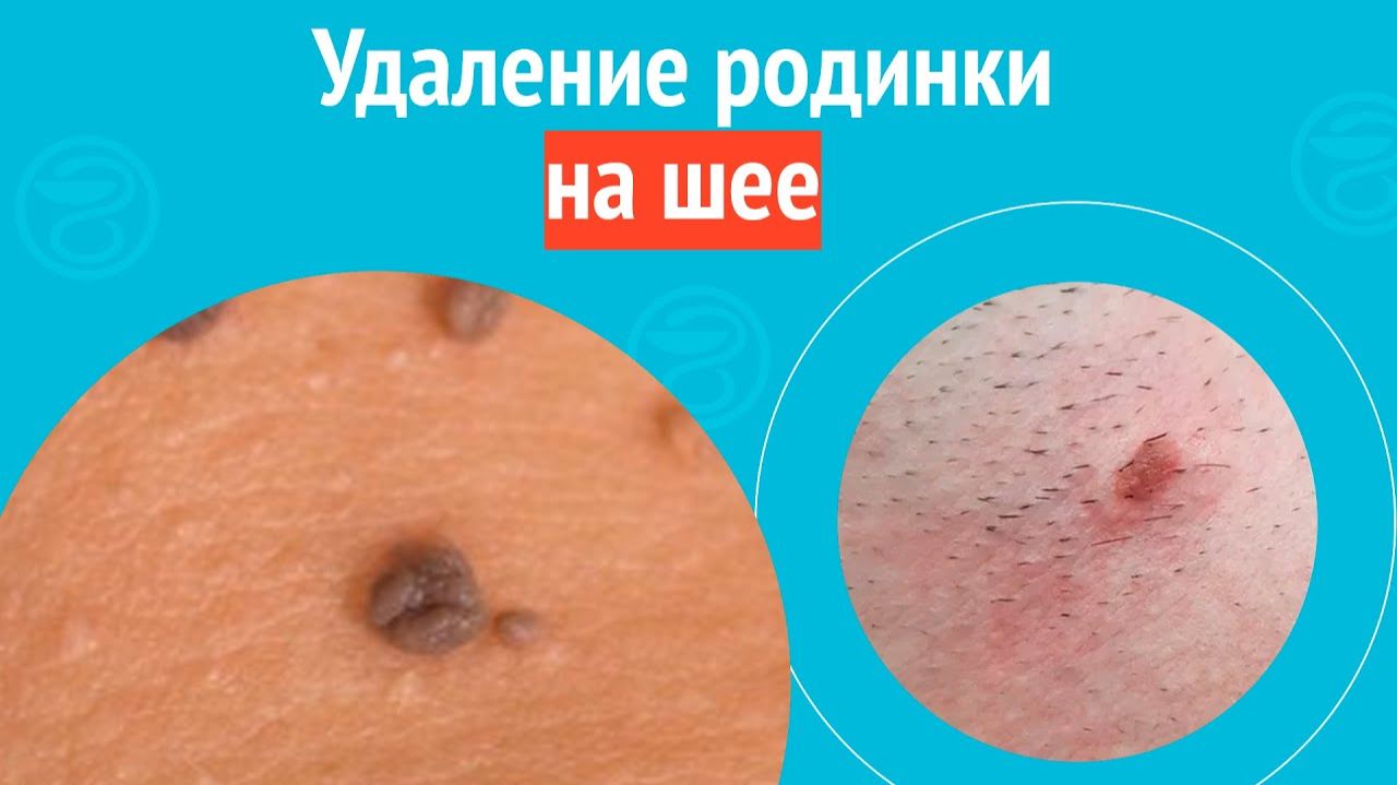 ✅ Удаление родинки на шее. Клинический случай №1533 смотреть онлайн