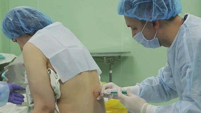 Эпидуральная анестезия во время родов смотреть онлайн