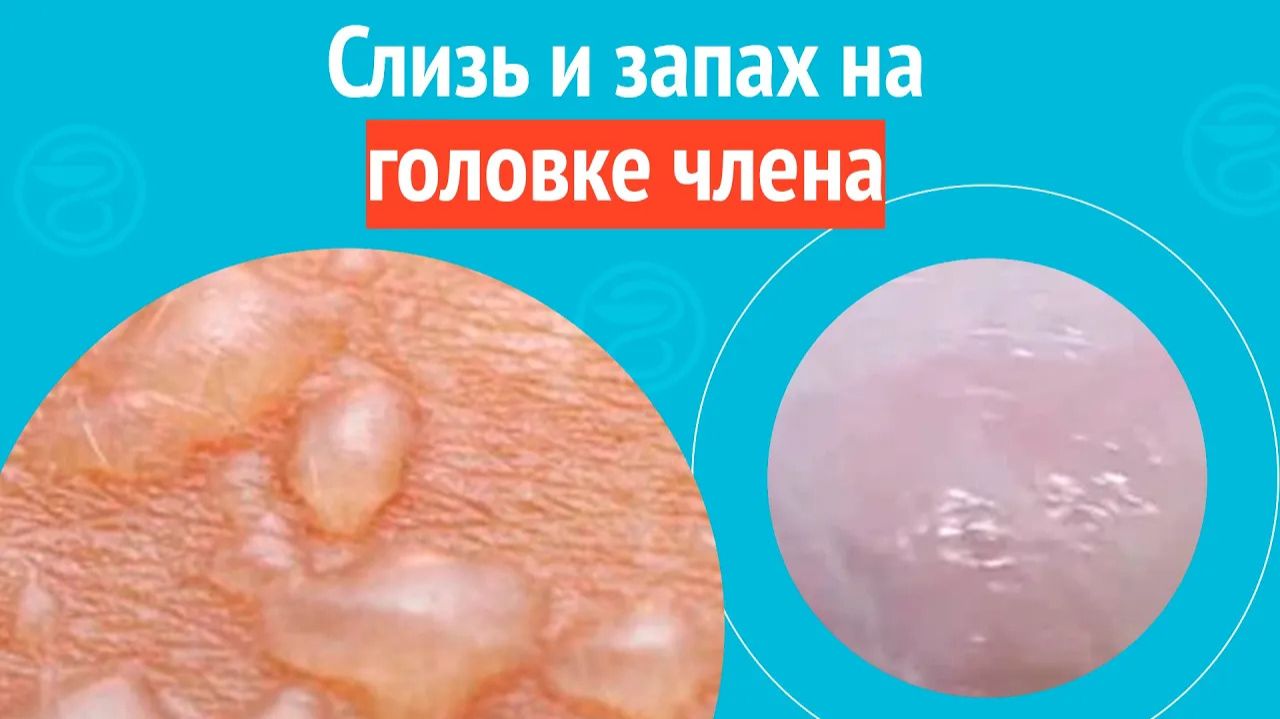 🙄 Слизь и запах на головке члена. Клинический случай №1536 смотреть онлайн