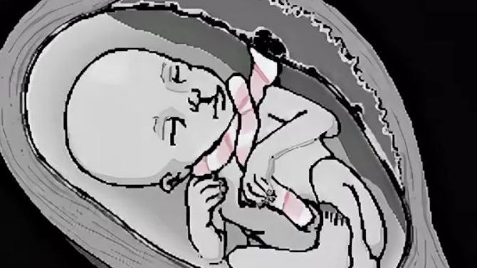 Внутриутробная гибель плода причины смотреть онлайн