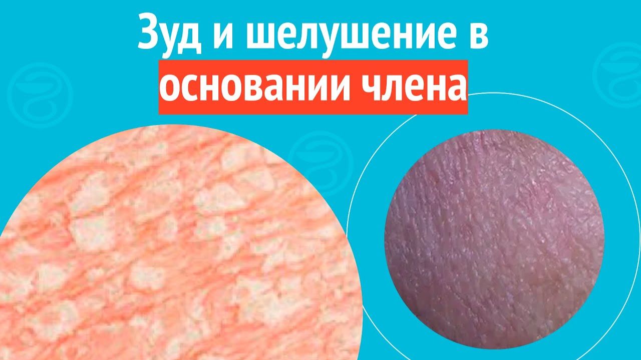 😒 Зуд и шелушение в основании члена. Клинический случай №1534 смотреть онлайн