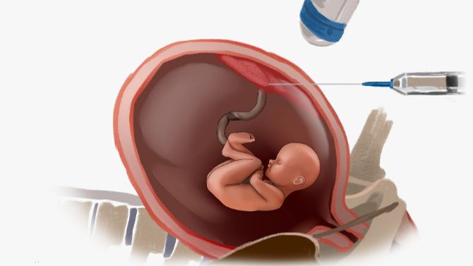 Анализ биопсия хориона смотреть онлайн