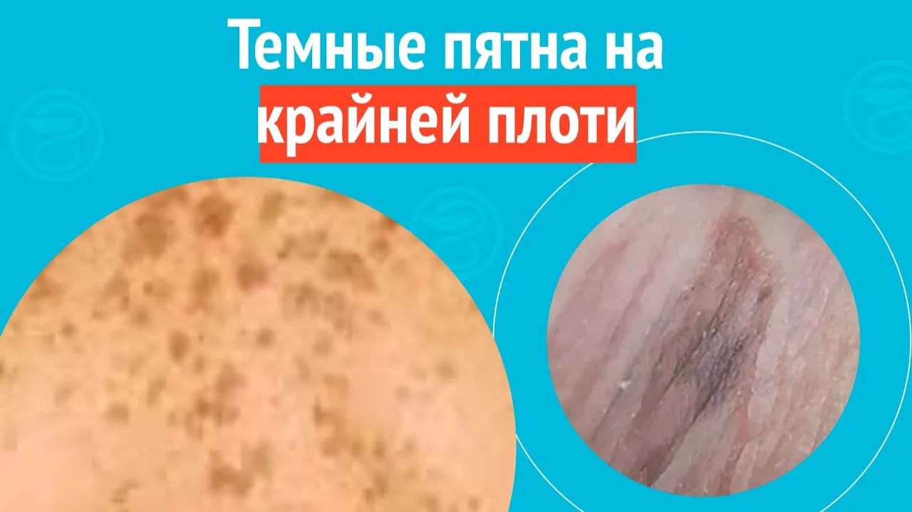 🙄 Темные пятна на крайней плоти. Клинический случай №1548 смотреть онлайн