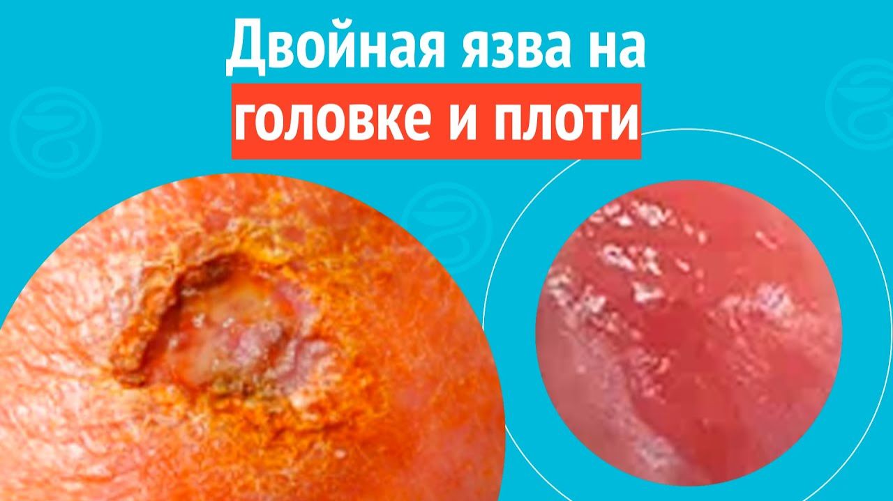 😲 Двойная язва на головке и плоти. Клинический случай №1563 смотреть онлайн