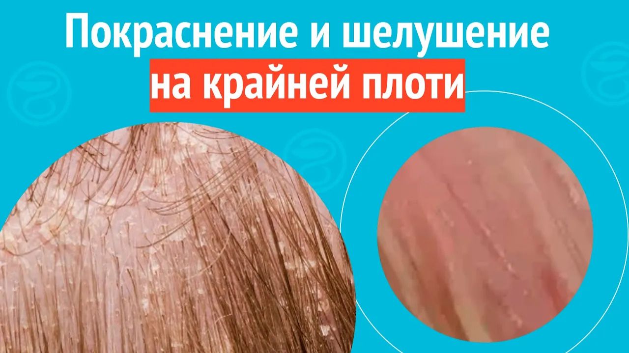 👉 Покраснение и шелушение на крайней плоти. Клинический случай №1559 смотреть онлайн