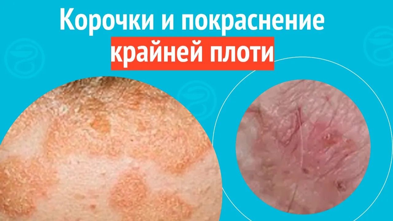 😡 Корочки и покраснение крайней плоти. Клинический случай №1564 смотреть онлайн