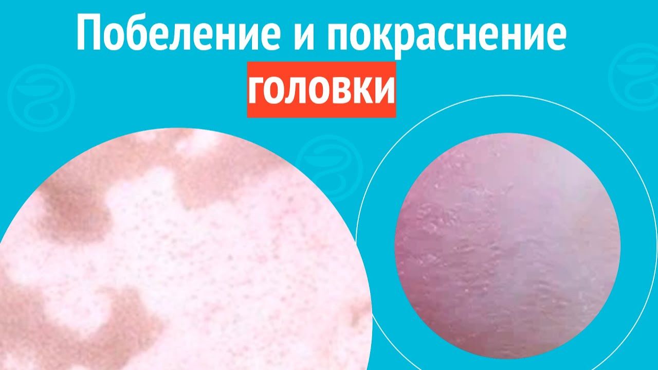 😡 Побеление и покраснение головки. Клинический случай №1546 смотреть онлайн