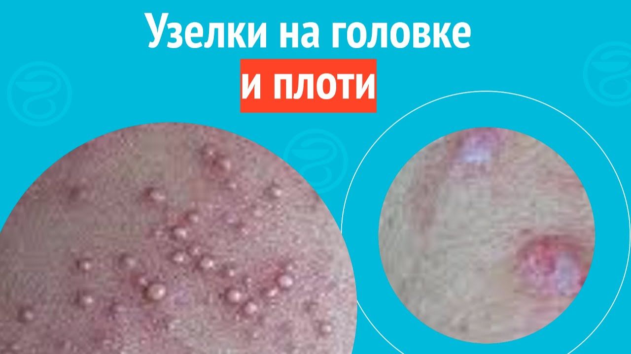 😦 Узелки на головке и плоти. Клинический случай №1569 смотреть онлайн
