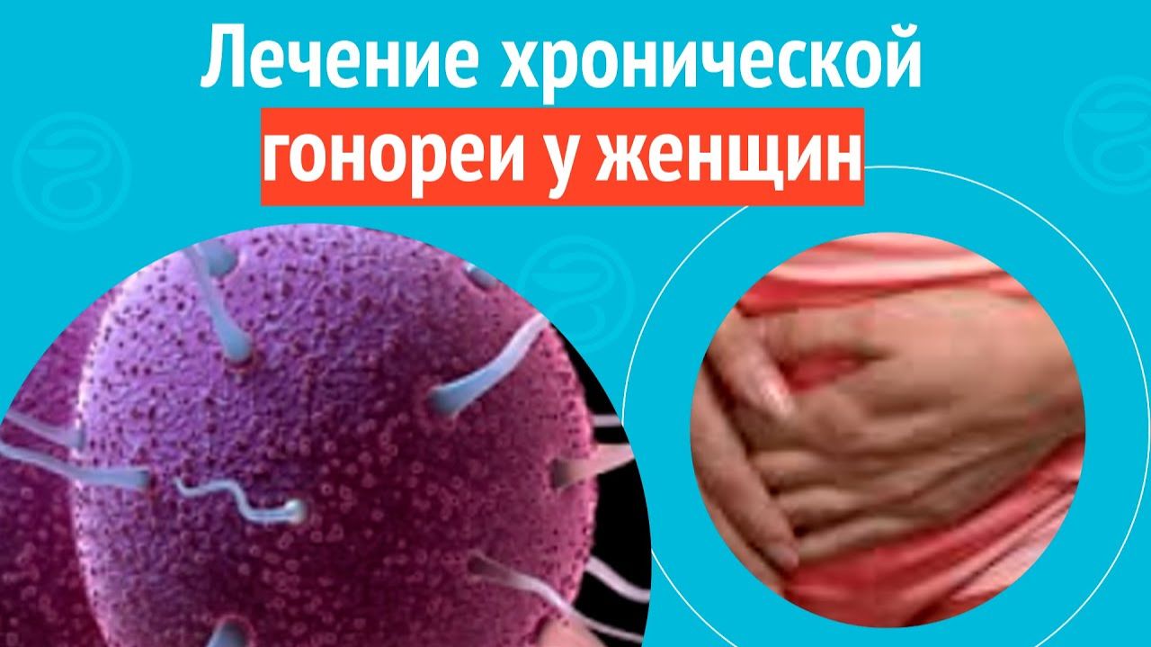 👩 Лечение хронической гонореи у женщин. Клинический случай №1570 смотреть онлайн