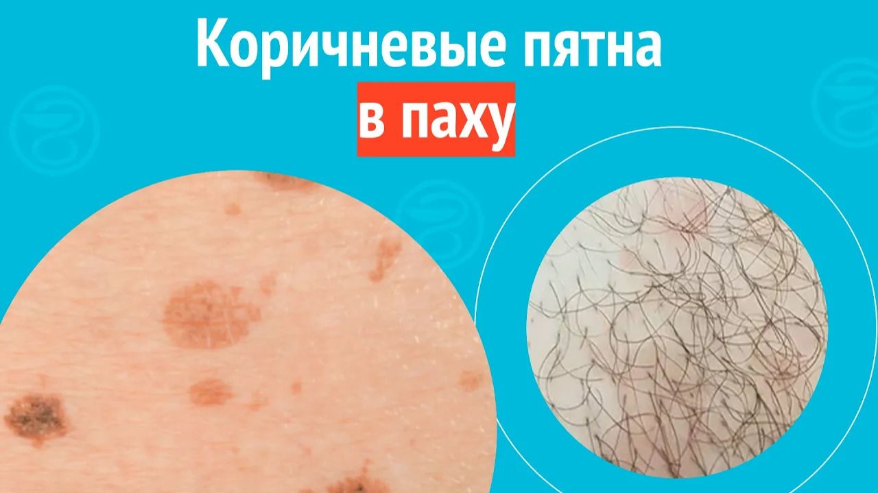 ⏸️ Коричневые пятна в паху. Клинический случай №1558 смотреть онлайн