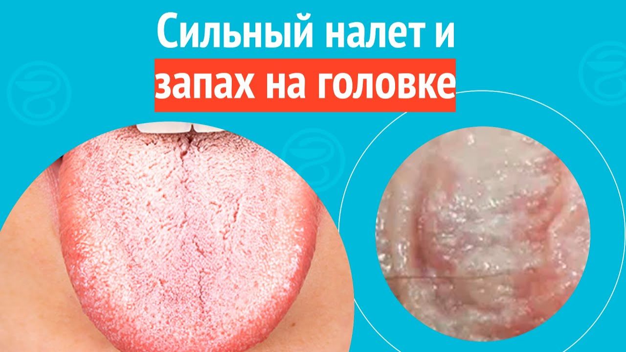 😒 Сильный налет и запах на головке. Клинический случай №1550 смотреть онлайн