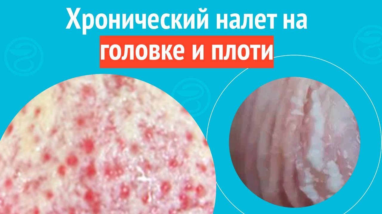 😰 Хронический налет на головке и плоти. Клинический случай №1542 смотреть онлайн