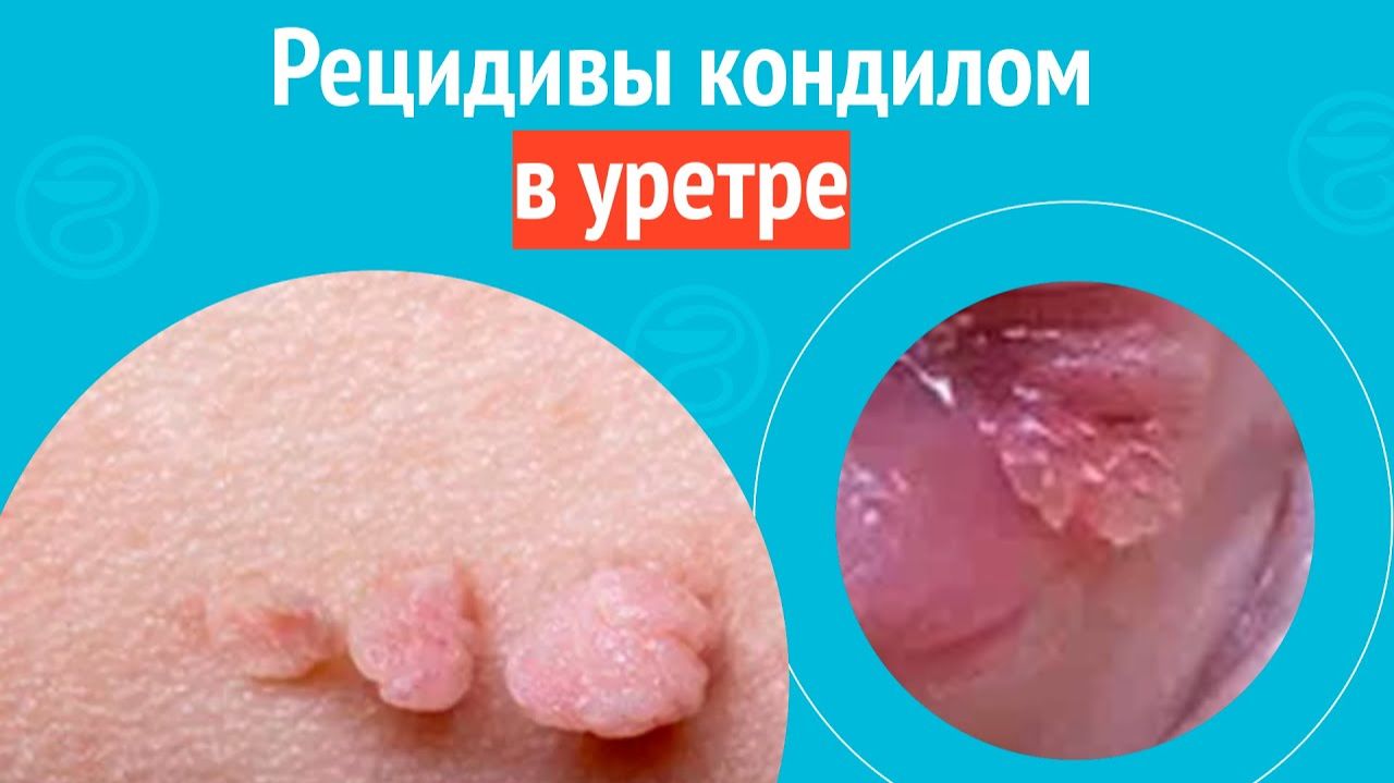 😨 Рецидивы кондилом в уретре. Клинический случай №1547 смотреть онлайн