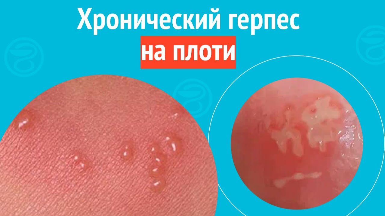 😒 Хронический герпес на плоти. Клинический случай №1545 смотреть онлайн